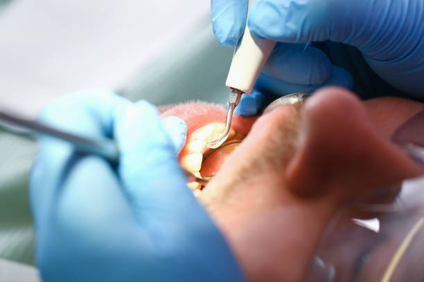 Best Emergency Dental Extractions in Culver, IN