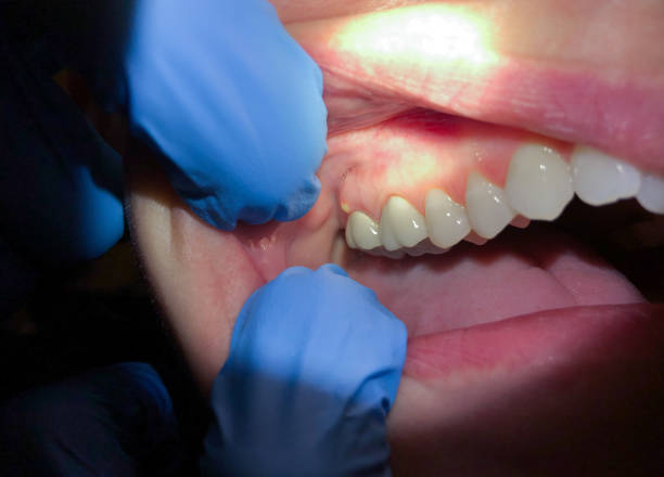 Best Emergency Dentist for Knocked-Out Tooth in Culver, IN